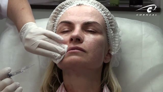 Корректируем периоральную зону (кисет) смотреть онлайн