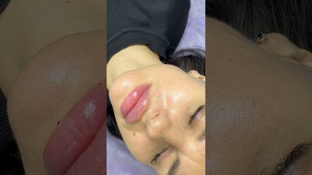 Контурная пластика губ, филлером на основе гиалуроновой кислоты. Результат сразу после процедуры