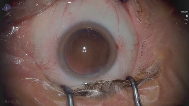 B+L LuxSmart EDOF in posterior sub capsular cataract Lukan Mishev live stream смотреть онлайн