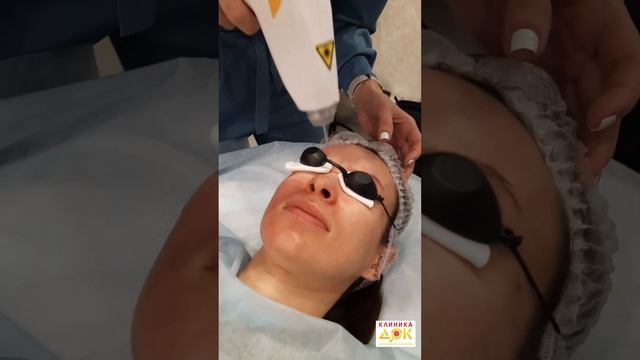 Лазерное удаление рубцов постакне смотреть онлайн