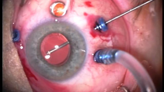 Vitrectomy with inverted ILM flap for macular hole смотреть онлайн