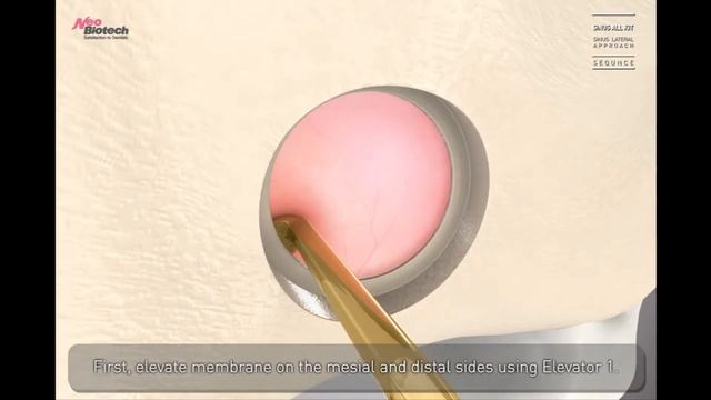 Sinus Lift: Sinus All Kit (Window Core) смотреть онлайн