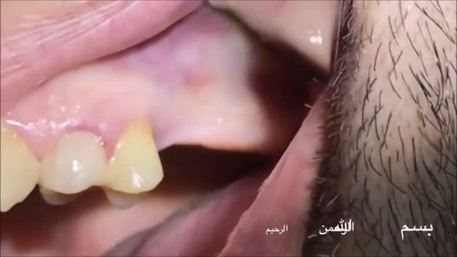 Sinus Lifting using Piezosurgery with immediate implantation смотреть онлайн