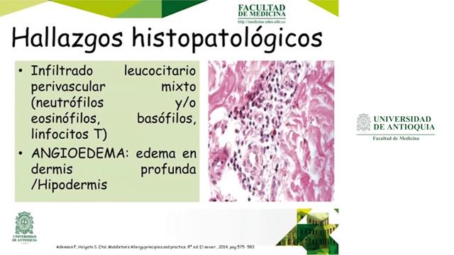 Fisiopatología urticaria crónica espontanea - Dra. Karent Betancur Castro смотреть онлайн