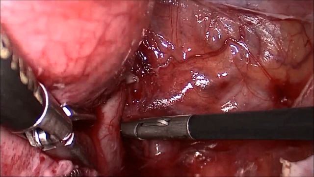 laparoscopic Cerclage and pelvic sentinel lymph node dissection (ICG) смотреть онлайн