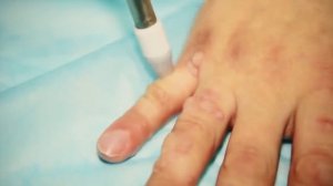 Бородавки на руках. Как избавиться от бородавки на пальце. Удаление бородавки жидким азотом