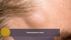 Жировики на теле, на лице: причины | Как избавиться от жировика (липомы)