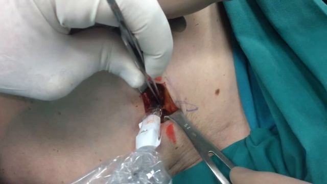 How to Do 13 - How to Perform Sentinel Node Biopsy w Probe смотреть онлайн