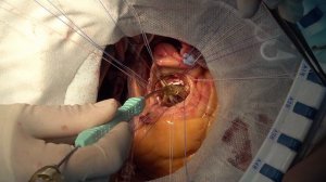 Имплантация биологического протеза клапана сердца «ЮниЛайн» Аортальный