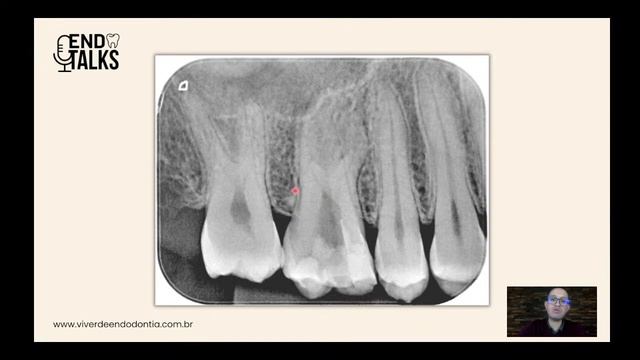 Complexidades anatômicas na clínica de Endodontia | EndoTalks смотреть онлайн