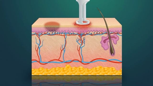 Excel V Laser Treats Bruising at Dermatology Institute of Atlanta смотреть онлайн
