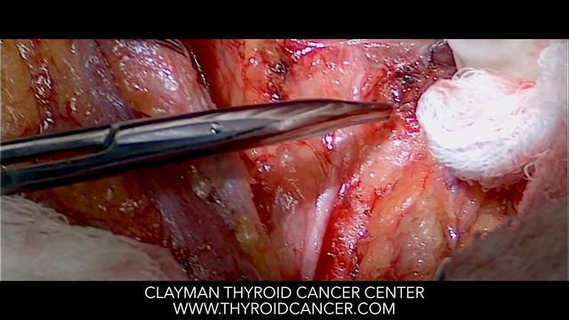 Total Thyroidectomy And Central Neck Dissection