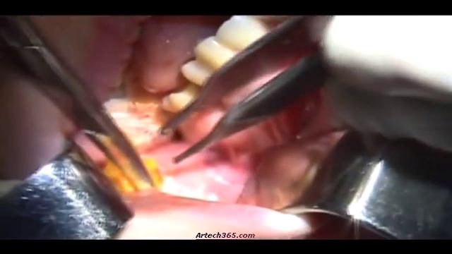 Bichats Fat Pad Removing смотреть онлайн