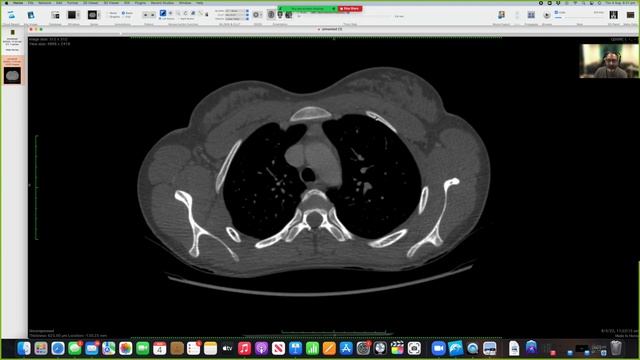 Anatomy of the Thoracic Wall and Thoracic Lymph Node Stations on CT смотреть онлайн