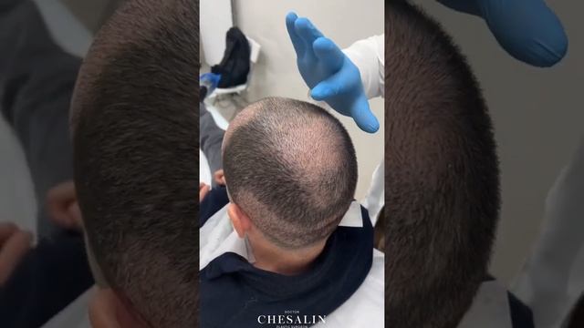 Трансплантация (пересадка) волос. Пластический хирург Иван Чесалин смотреть онлайн