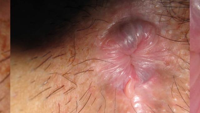 Female hemorrhoids: photos of pregnancy, pictures of hemorrhoid skin tags, piles fissures смотреть онлайн