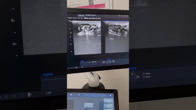 Варикоцеле у парня 25 лет. Для записи на прием пишите пожалуйста в вацап 89250423646 Флеболог Москва смотреть онлайн