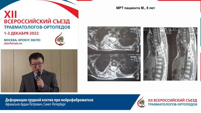 Деформации грудной клетки при нейрофиброматозе Афанасьев Ардан Петрович, ... смотреть онлайн