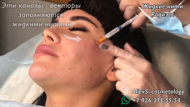 Жидкие нити Radiess. Контурная пластика лица по нашей методике смотреть онлайн