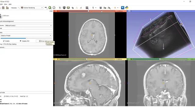 Volume rendering and ROI on brain tumour using 3D Slicer смотреть онлайн