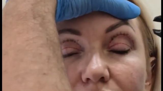 Объёмное омоложение верхних век. Исправление скелетизации.