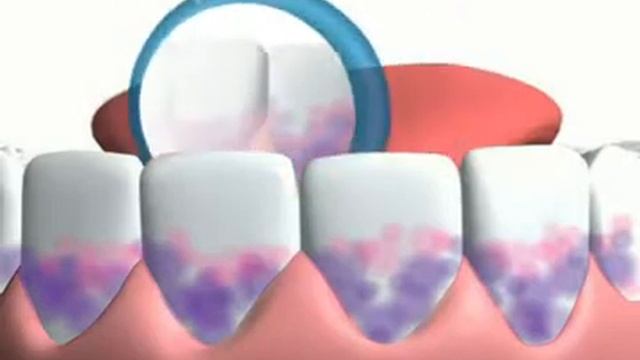 Plaque Check - индикаторы налёта смотреть онлайн