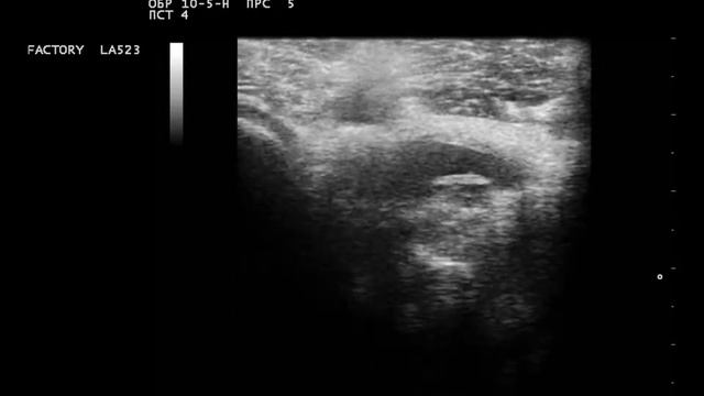 подколенная ямка смотреть онлайн