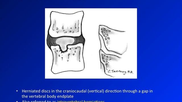 Basic spine imaging - ch 3 - degenerative disease смотреть онлайн