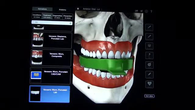 Виниры, ультраниры, люминиры. смотреть онлайн