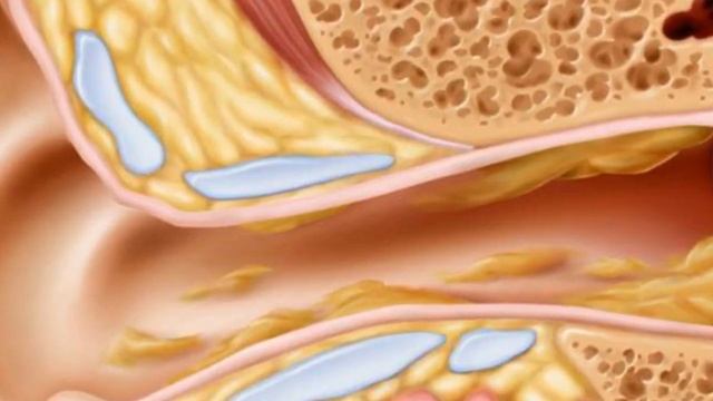 Пробка в ухе. Народное лечение. смотреть онлайн