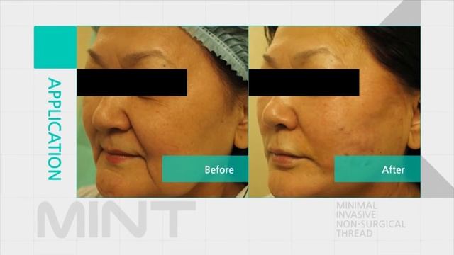 Особенности нитей MINT для подтяжки лица Обрезка 06 смотреть онлайн