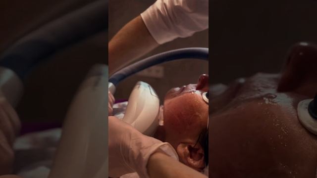 Фотоомоложение на аппарате М22: быстро, эффективно, безопасно смотреть онлайн