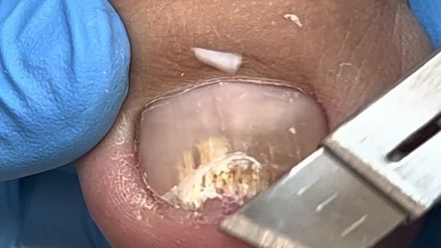 Trim Off Broken Toenails! Nail Fungus Treatment【Xue Yidao Pedicure】