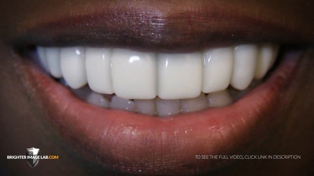 See This Challenge Smile Makeover By Brighter Image Lab смотреть онлайн