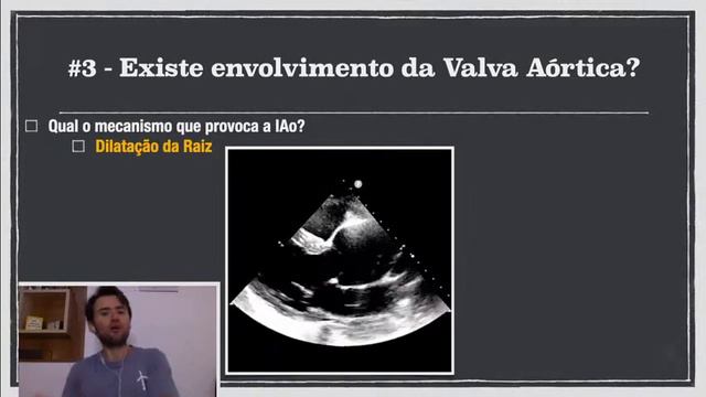 Aula 03 - Dissecção de Aorta - O que não posso deixar de ver no ECO? смотреть онлайн