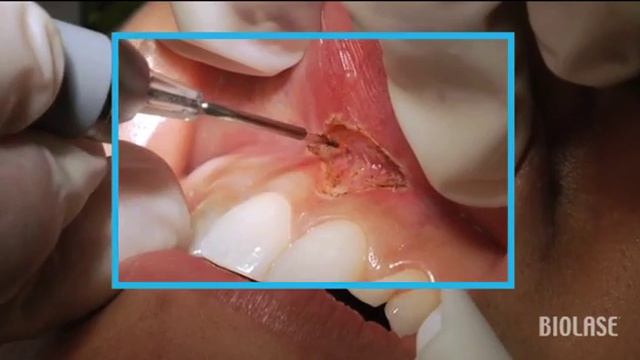 Френектомия смотреть онлайн