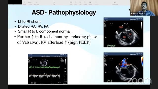 CHD patient for non-cardiac surgery- Dr Thomas Koshy, Kerala смотреть онлайн