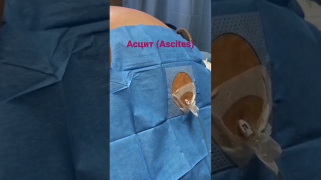 Ascites (Асцит ) смотреть онлайн