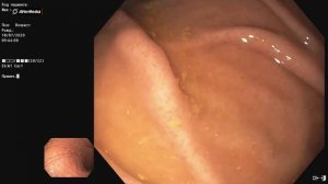 Гастроскопия, норма. ФГДС. ЭГДС. Эндоскопия.