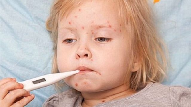 Краснуха у детей симптомы смотреть онлайн