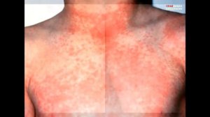 Симптомы ВИЧ у мужчин