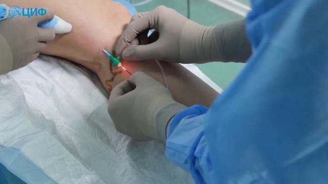 Инновационная методика - лазерная коагуляция смотреть онлайн