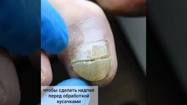 Обработка ногтей онихогрифоз смотреть онлайн