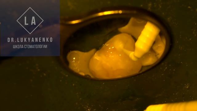 STOMAФИШКИ#1 Лечение перед установкой керамической накладки смотреть онлайн