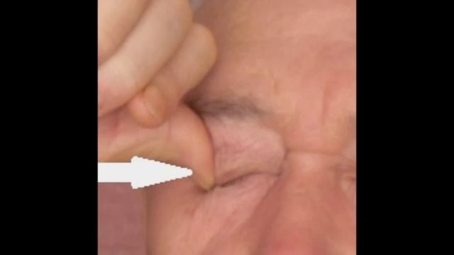 Восстановление дальнозоркости