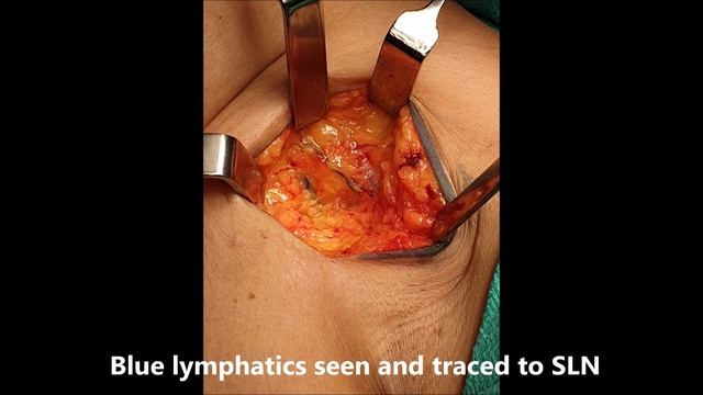 Sentinel Lymph Node Biopsy in Breast Cancer by Dr Vipin Goel смотреть онлайн