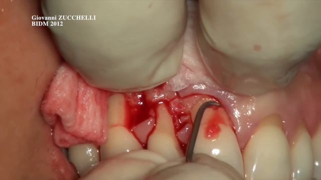 Coronally Advanced Flap For Multiple Recession Defects: G. ZUCCHELLI