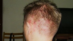 Причины прыщей на голове в волосах?