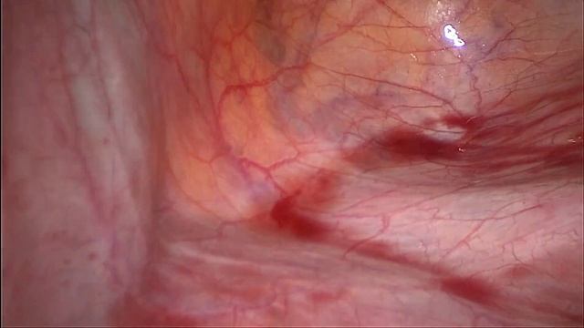 Indocyanine green in detection of sentinel lymph nodes in cervical cancer. CORDOBA смотреть онлайн
