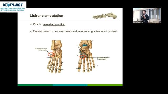 ICOPLAST Lower limb reconstruction diabetic ulcers; rehabilitation perpective смотреть онлайн